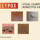 Image for article titled Don't Mistake These Skin Conditions for Monkeypox